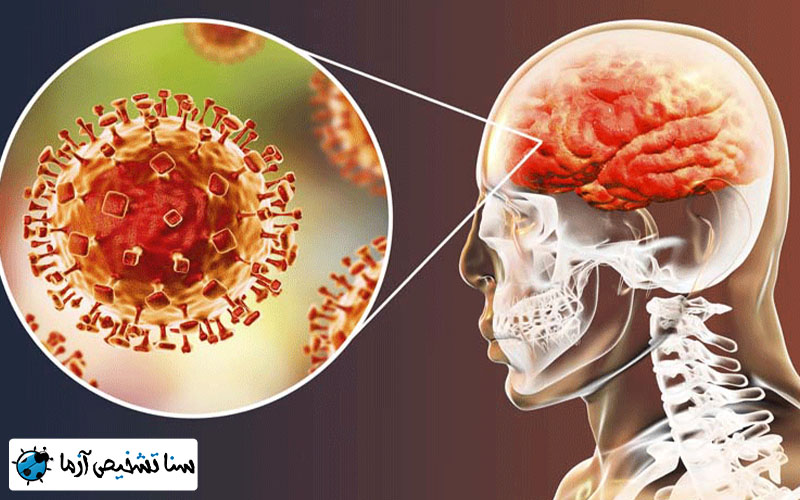 مننژیت چیست و چه انواعی دارد؟ مننژیت باکتریایی، مننژیت ویروسی، مننژیت قارچی